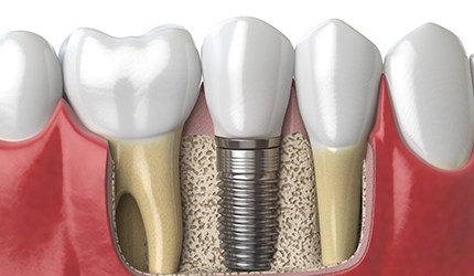 3D image of a lower dental implant in DeSoto