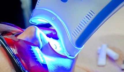 In-office whitening treatment