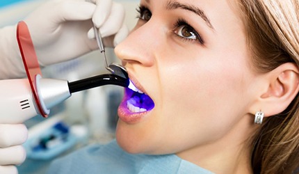 woman getting dental bonding hardened with ultraviolet curing light 