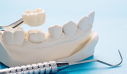 Dental crown being placed on model jaw