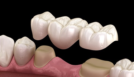 Illustration of a dental bridge to replace one tooth