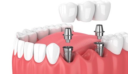 Two dental implants complete with abutments and dental crowns
