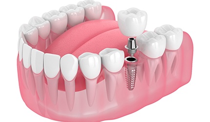 Illustration of a single dental implant