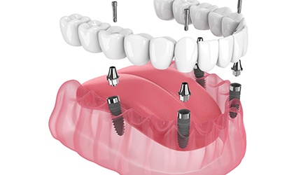 Illustration of an implant denture