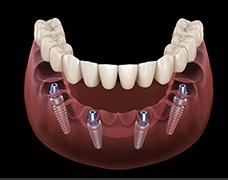 Implant supported denture animation