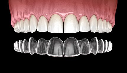 Model of Invisalign and upper arch of teeth