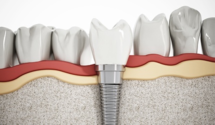 Animation of implant supported dental crown