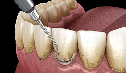 Scaling and root planing protects your teeth and gums from gum disease