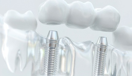 implant-retained dental bridge in DeSoto model