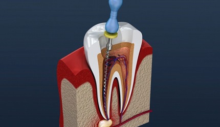 woman with toothache about to receive root canal therapy in DeSoto