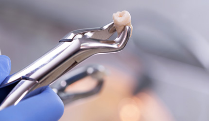 Up-close view of dental pliers holding extracted tooth 