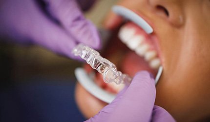 dentist putting SureSmile aligners on patient 