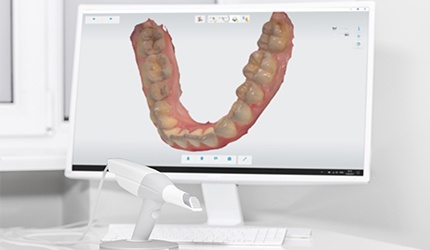 Digital bite impression on computer screen