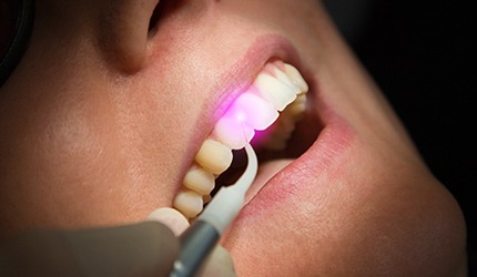 Patient receiving soft tissue laser dental treatment