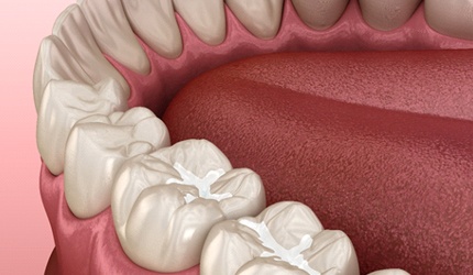 Digital illustration of composite resin fillings in DeSoto