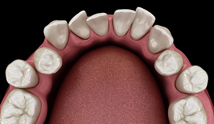 a digital illustration of crooked teeth