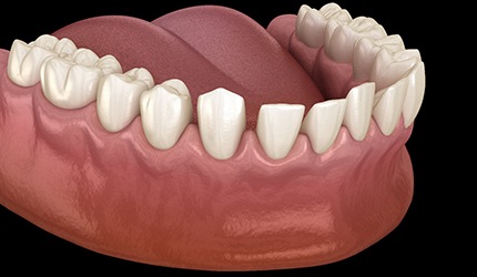 a digital illustration of gapped teeth