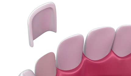 Closeup of model demonstrating porcelain veneers in DeSoto