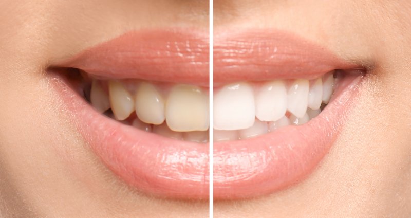 Closeup of teeth whitening before and after