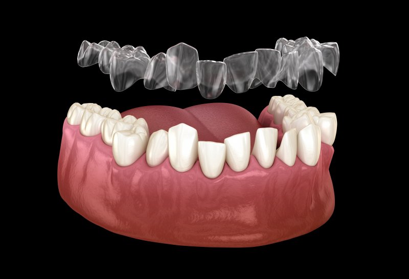 3D illustration of Invisalign correcting bite problems